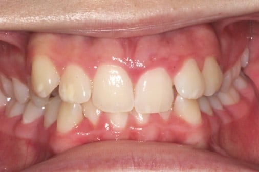 Before clear braces treatment, Milk Orthodontics Auckland