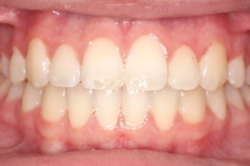 After expander and classic braces, Milk Orthodontics Auckland