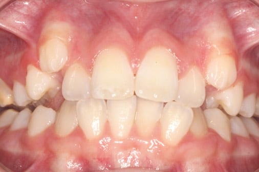 Before expander and braces treatment, Milk Orthodontics Auckland