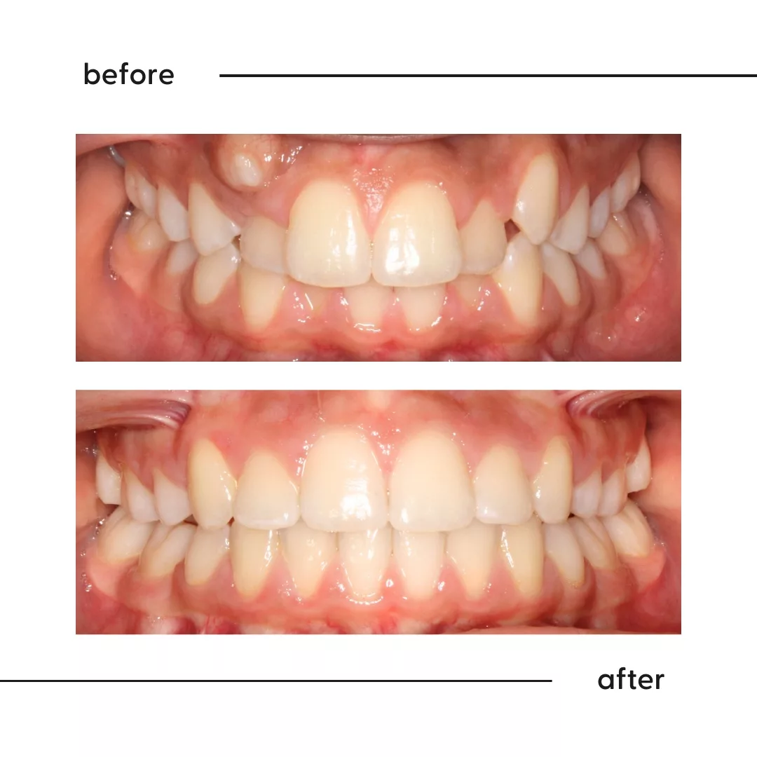 Before and after of high canines aligned by a specialist orthodontist in Auckland