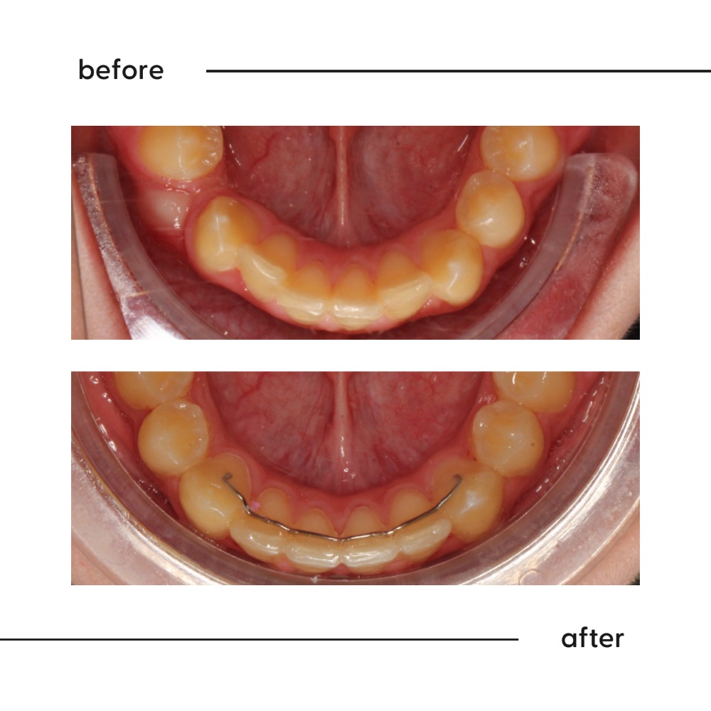 Before and after looking down at a crowded lower arch aligned into a smooth curve, Auckland
