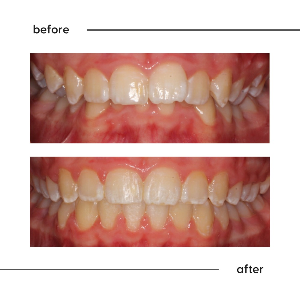 Before and after of a deep bite opened so the lower teeth show, orthodontic result Auckland