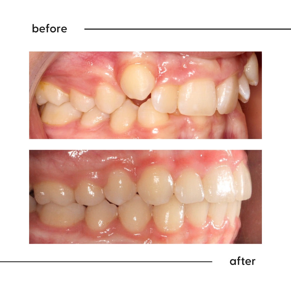 Before and after of a high canine tooth brought down into the smile, Auckland orthodontic result