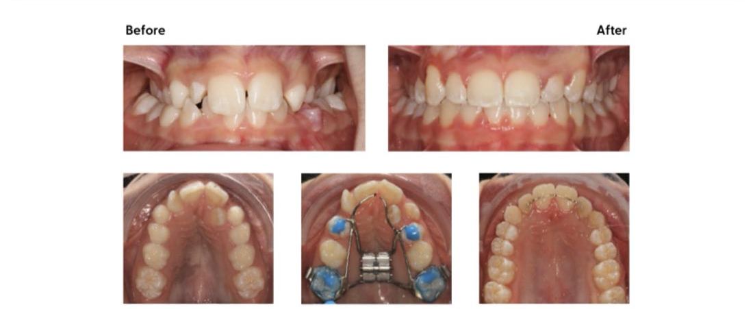 Before and after treatment of a posterior crossbite with a palatal expander at Milk Orthodontics, Auckland