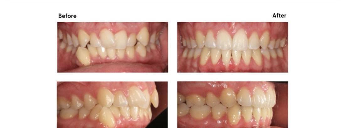 Before and after of crowded teeth straightened at Milk Orthodontics, Auckland