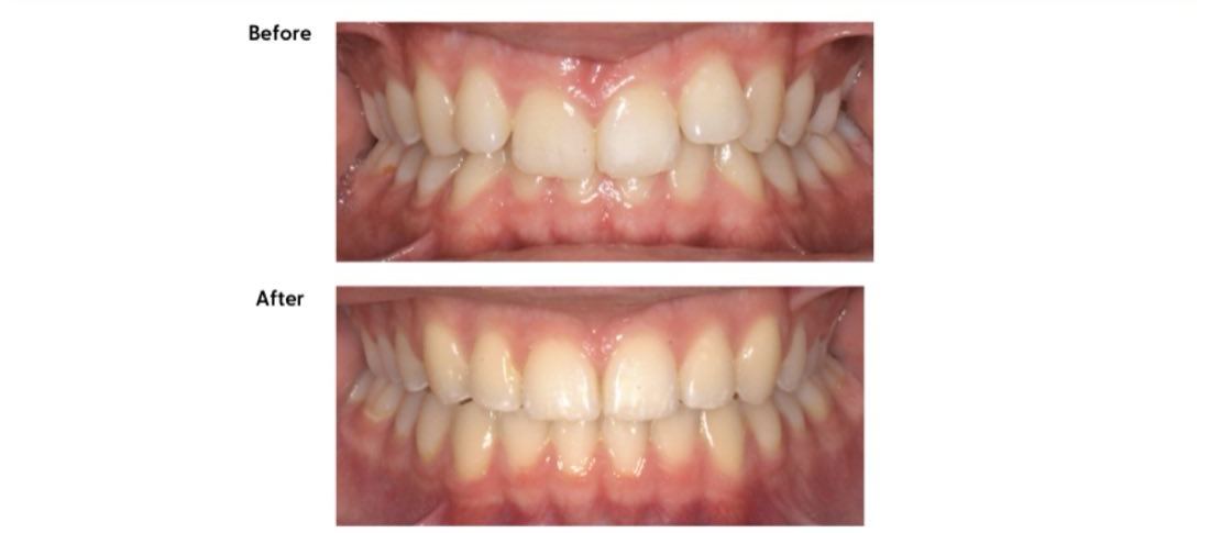 Before and after treatment of a deep overbite at Milk Orthodontics, Auckland