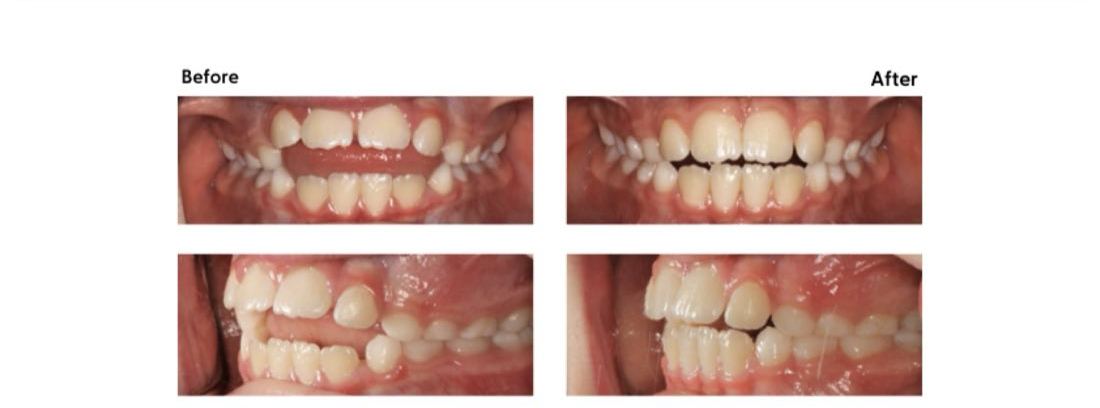 Before and after of an anterior open bite that closed after a thumb-sucking habit stopped, at Milk Orthodontics, Auckland