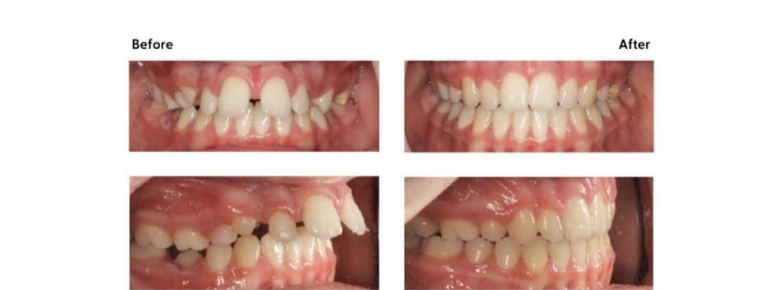 Before and after of an overbite corrected at Milk Orthodontics, Auckland