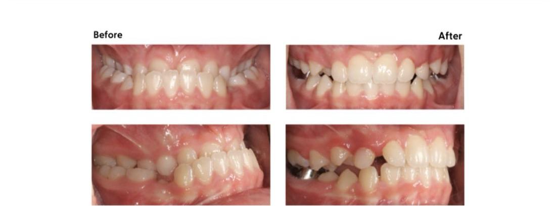 Before and after of an underbite corrected at Milk Orthodontics, Auckland