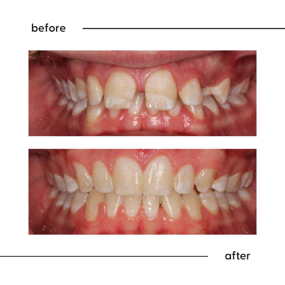 Before and after of a wide gap between front teeth closed with orthodontic treatment in Auckland